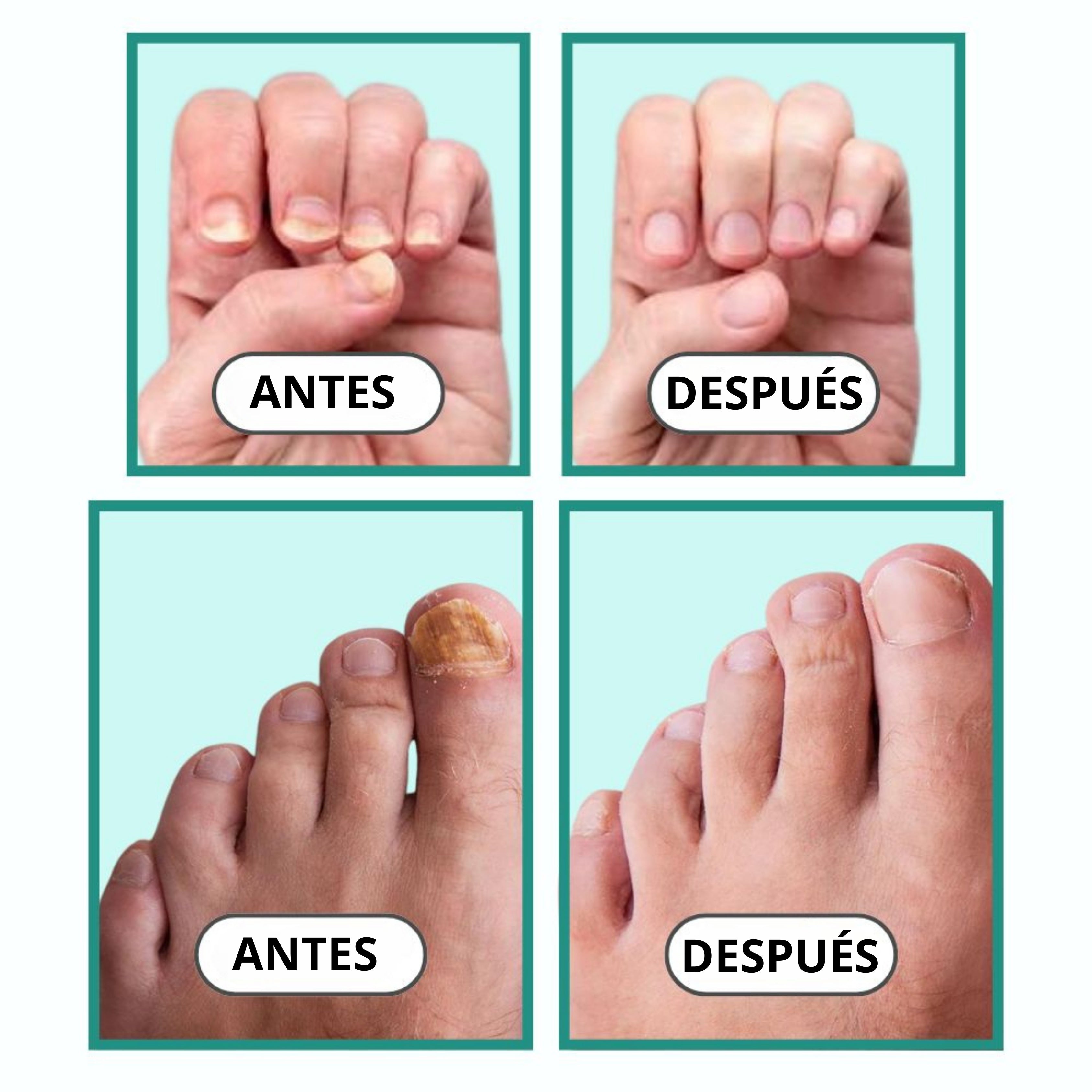 Aparato Antimicótico