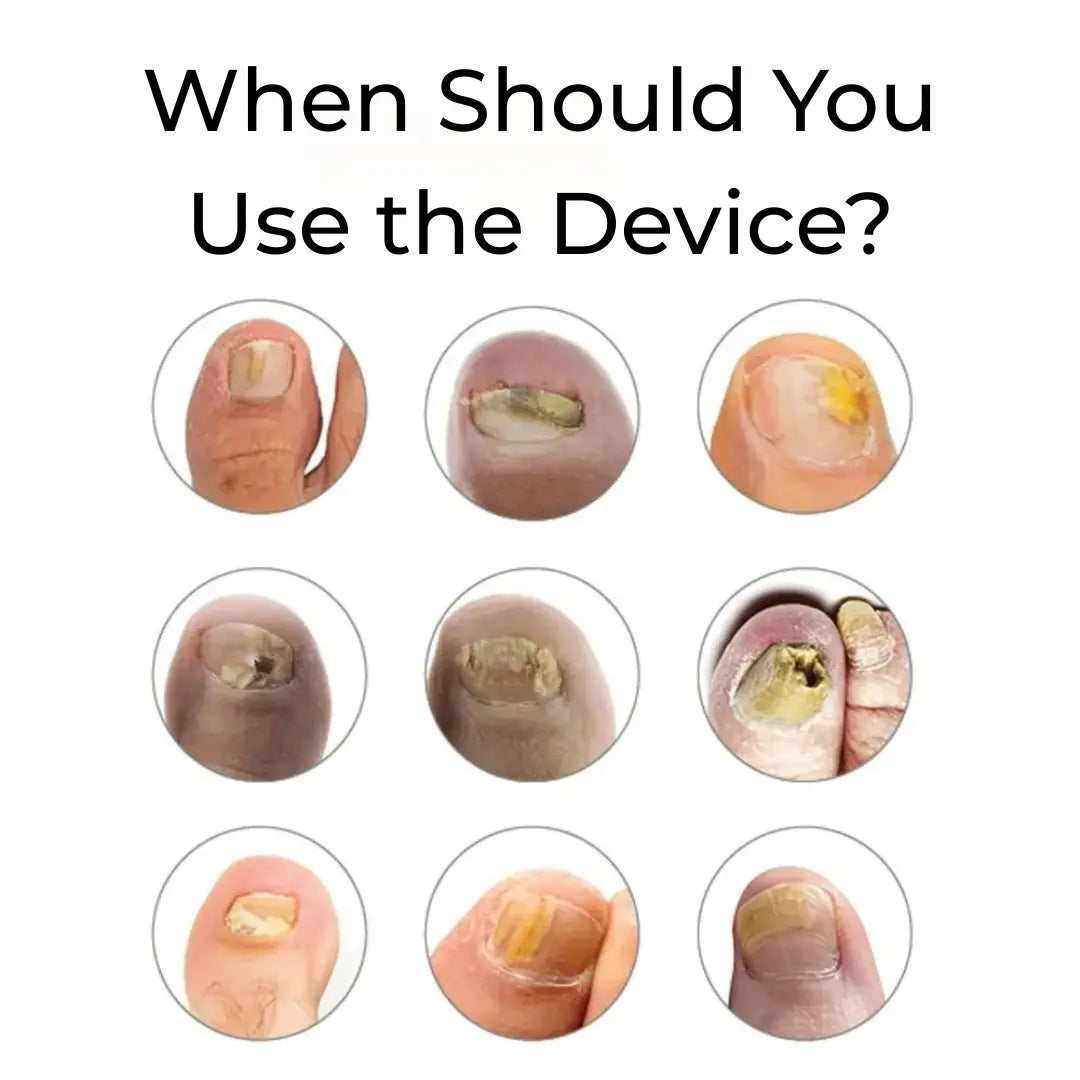 Antifungal Device