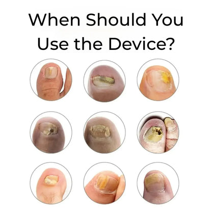Antifungal Device